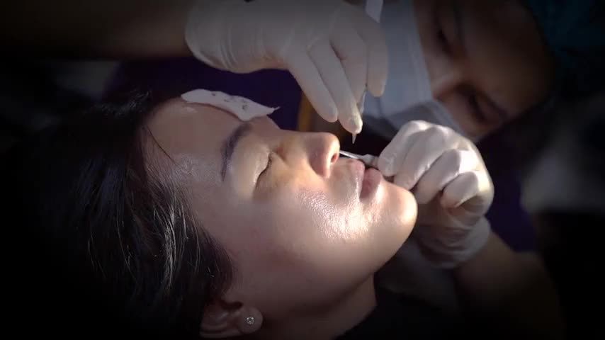 Cận cảnh quy trình cắt chỉ tháo băng sau 10 ngày thực hiện Nâng mũi