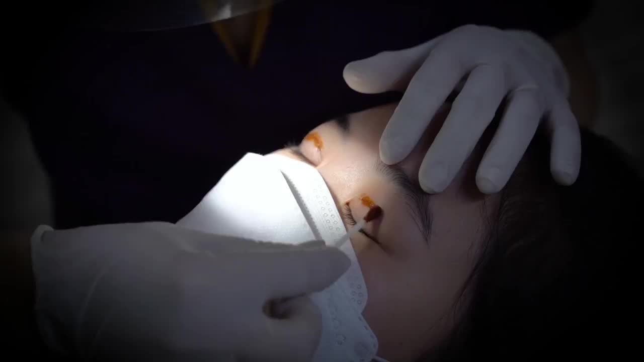 Cùng xem quá trình cắt chỉ sau khi 7 ngày cắt mí tại Dr.Hải Lê