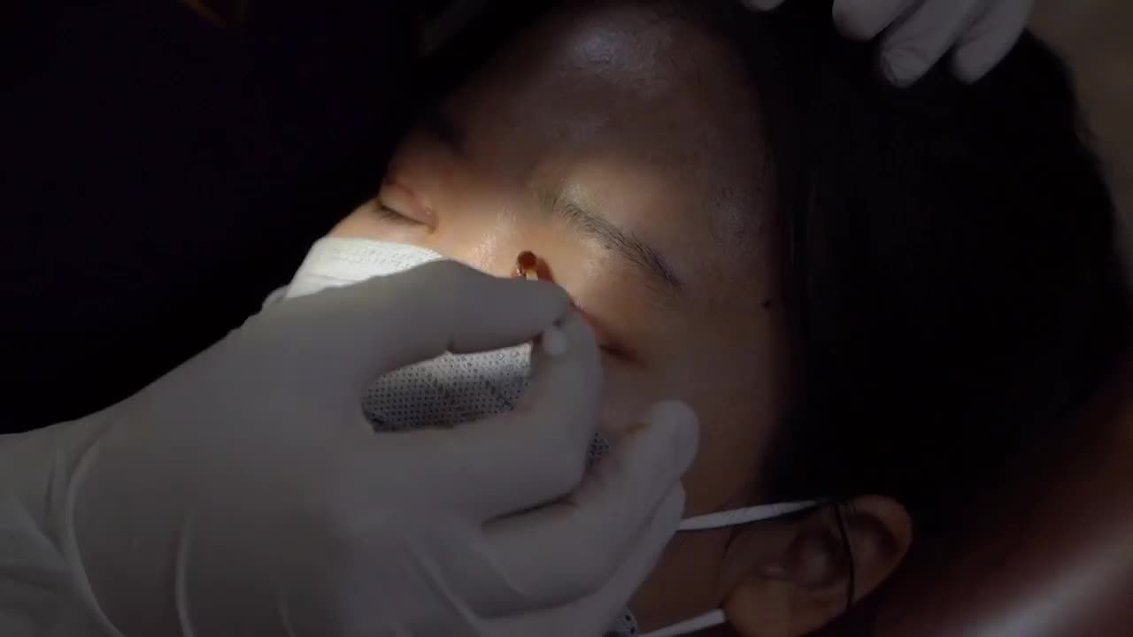 Chiêm ngưỡng ngay quá trình cắt chỉ mí sau 7 ngày