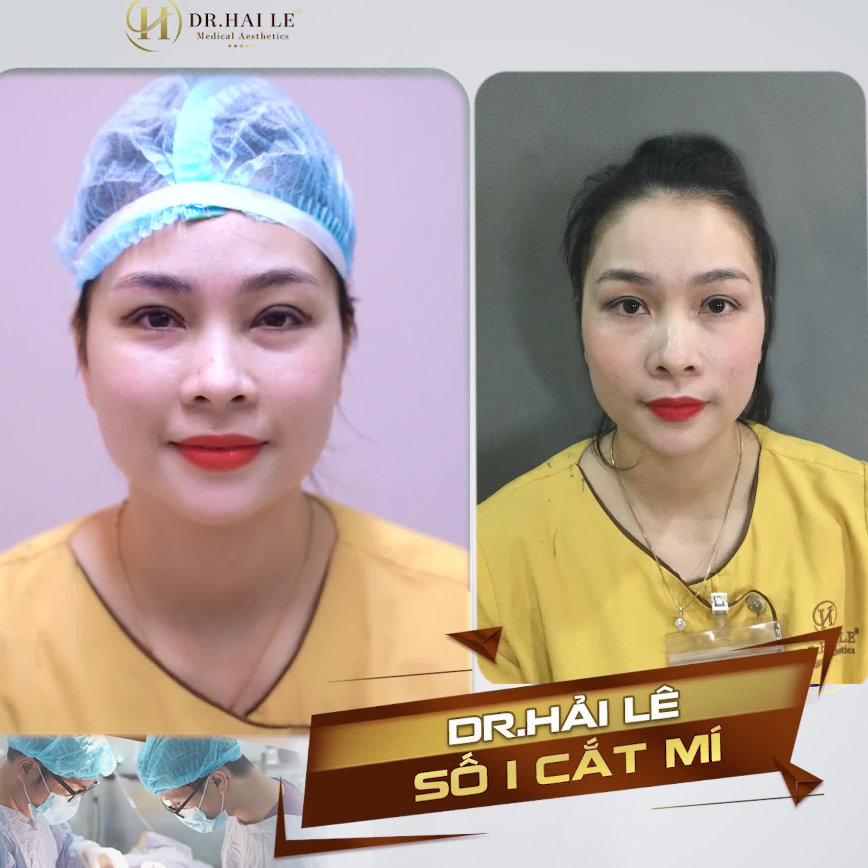 Công nhận, cắt mí xong chụp ảnh nhìn góc nào cũng đẹp.