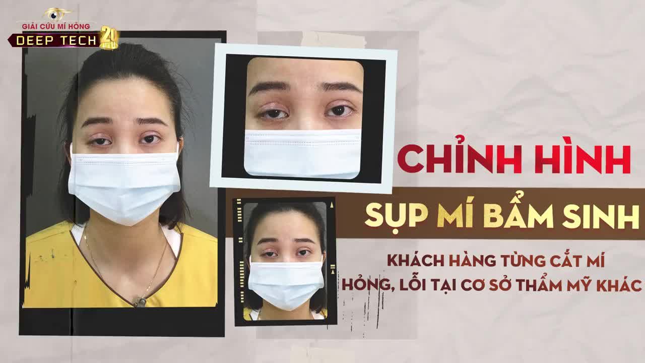 Từng cắt mí nhiều lần tại cơ sở thẩm mỹ khác, nhưng càng sửa càng tệ