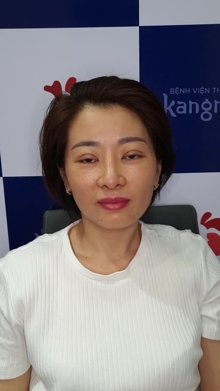 5 ngày sau cắt mí  Đẹp không ngờ bão like cho Kangnam