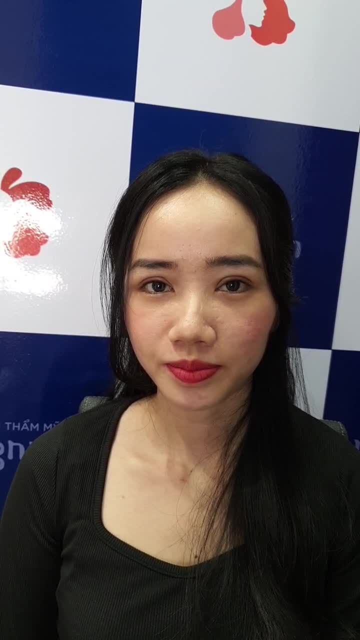 Cặp mí mới cắt 7 ngày mà trông đều đẹp, siêu tự nhiên