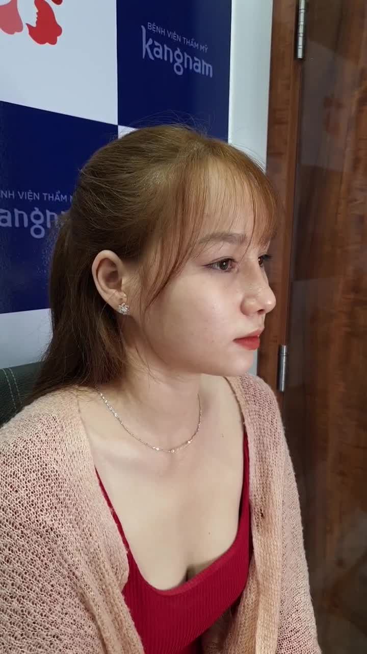Hoá hot girl sau khi nâng mũi tại Bệnh viện Kangnam bạn có tin không