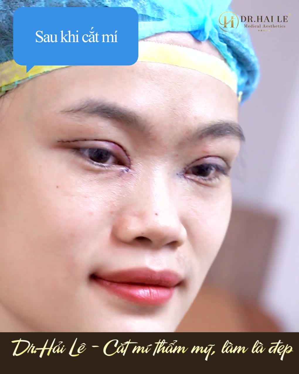 Trước khi quyết định cắt mí từng đắn đo suy nghĩ rất lâu
