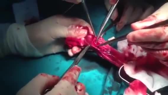 Phẫu thuật cấp cứu gãy dương vật - vỡ vật hang