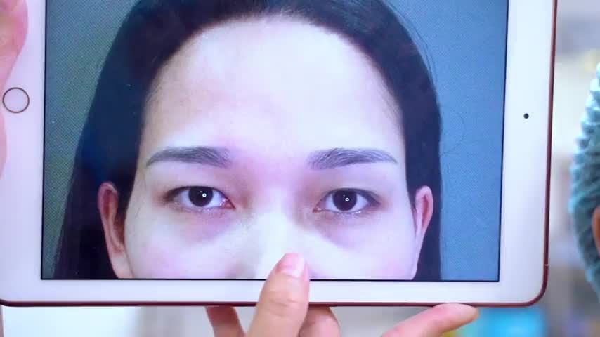 Độn vùng trên gò má khắc phục thái dương hóp gò má cao hiệu quả như thế nào Mời quý khách hàng cùng theo dõi