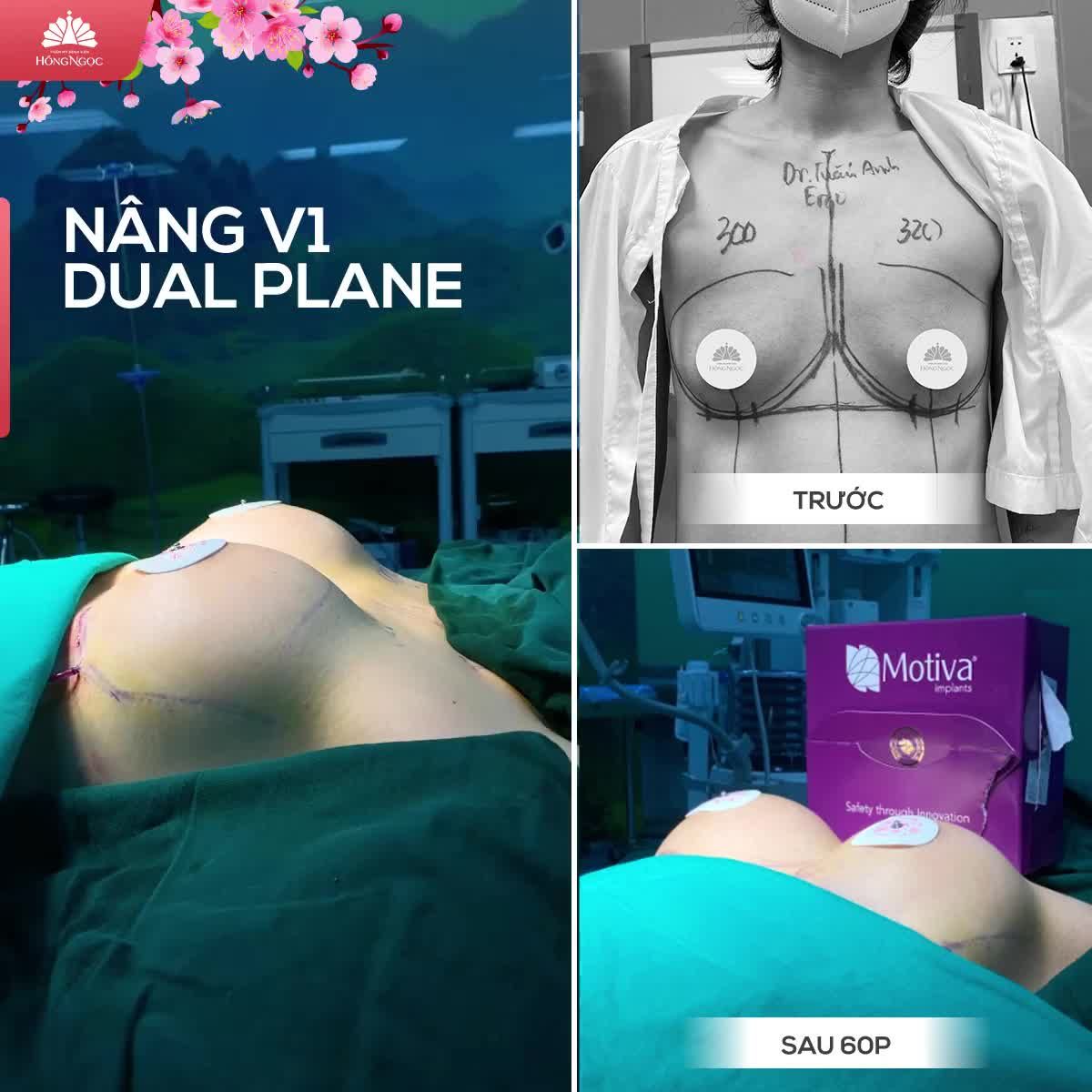 TEO LÉP HÓA CĂNG TRÒN CHỈ SAU 60P NÂNG V1 DUAL PLANE