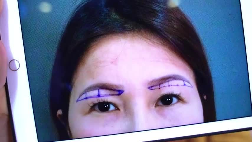 Mắt sụp mí tuổi ngoài 30 có giải pháp nào có thể khắc phục Mời quý khách hàng cùng theo dõi