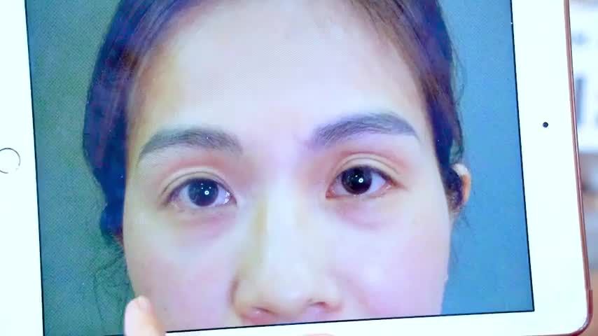 Nếu được chọn lại lần nữa tôi nhất quyết vẫn sẽ chọn Dr.Hải Lê để làm Mí Mắt vì kết quả đẹp ngoài sự mong chờ của tôi