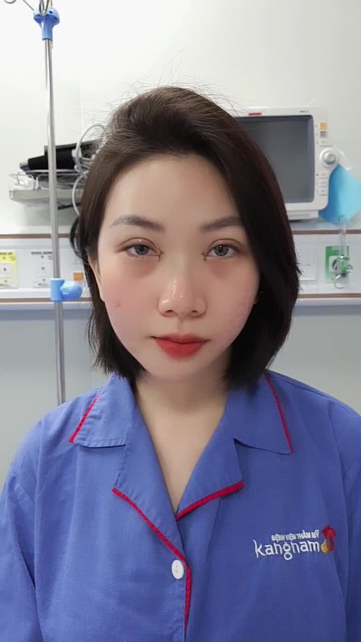 Hóa hotgirl Hàn quốc nhờ combo Cắt mí+ tạo khóe mắt trong