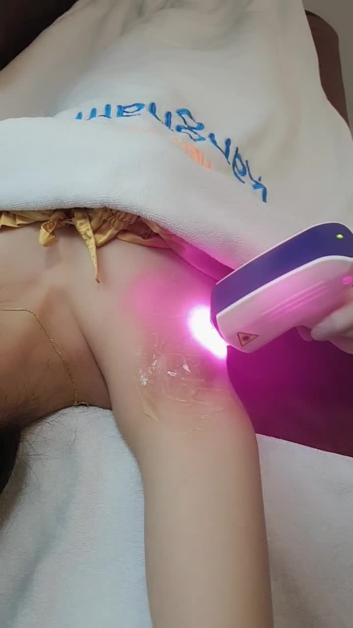 công nghệ triệt lông hiệu quả nhất hiện nayTriệt lông Diode Laser