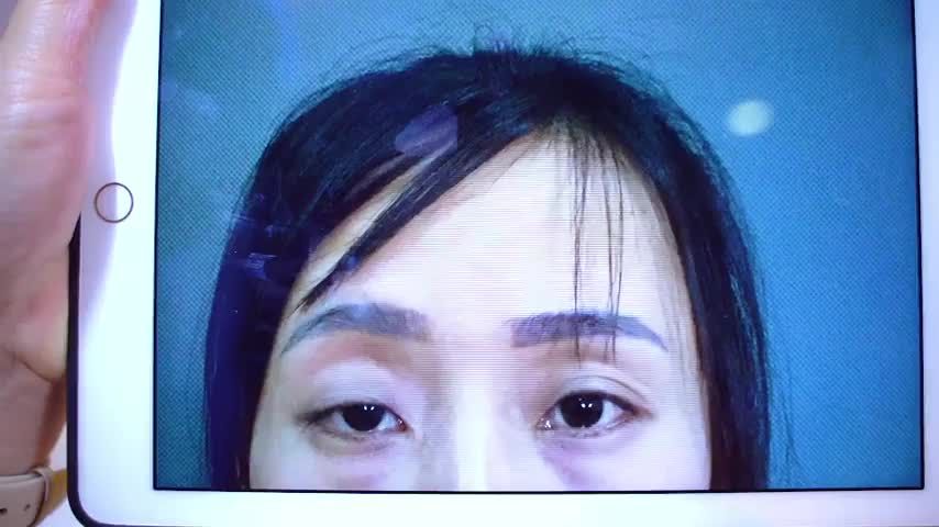 Dr.Hải Lê số 1 phẫu thuật chỉnh hình mí mắt sụp bẩm sinh thành công ngoài sự mong đợi.