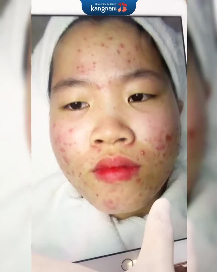 Mụn viêm toàn mặt khá nặng, điều trị tại nhà không dứt điểm