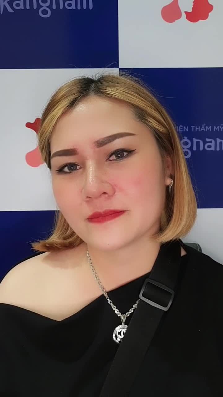 Nâng mũi xong đẹp ngoài mong đợi lời chia sẻ hạnh phúc từ chị KH Việt kiều sau 10 ngày nâng mũi