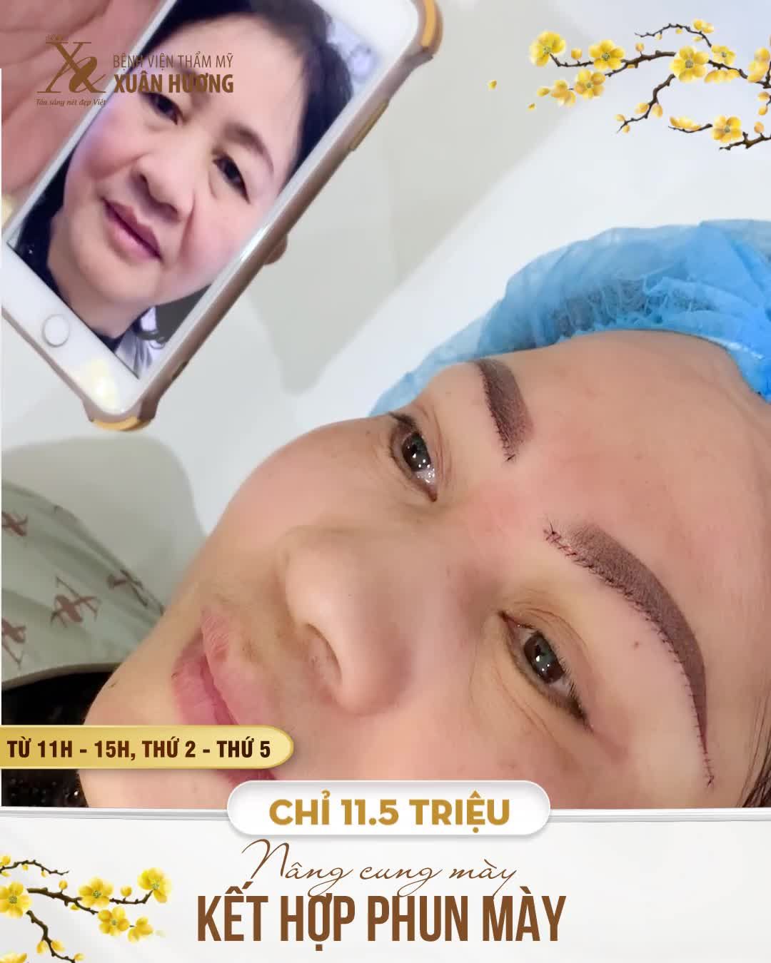 GẤP ĐÔI HIỆU QUẢ TRẺ HÓA GƯƠNG MẶT NHỜ ĐỒNG THỜI KÉO CĂNG DA CHÙNG MÍ TRÊN + KIẾN TẠO DÁNG MÀY THỜI THƯỢNG