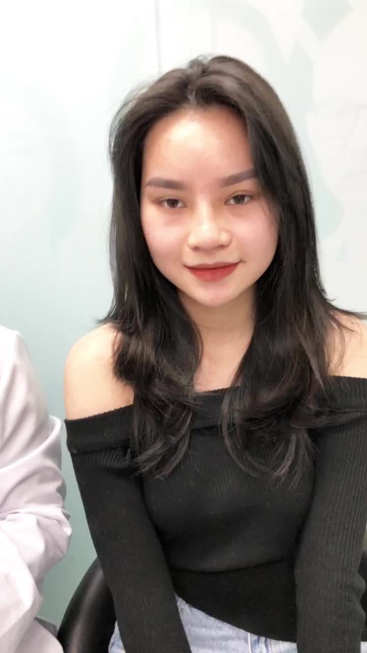 Cực phẩm nâng mũi sau 10 ngày