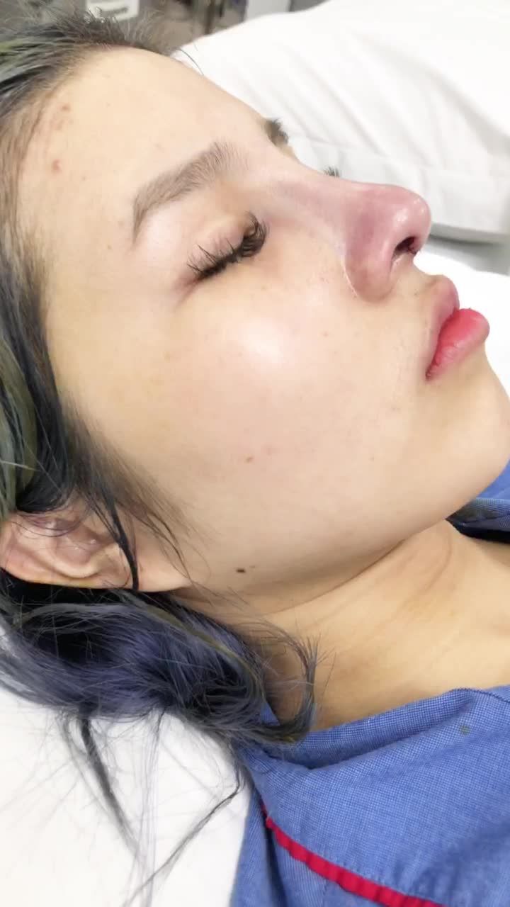 Siêu phẩm nâng mũi cấu trúc 4D cực đẹp giành cho cô gái trẻ 24t tại BVTM KANGNAM