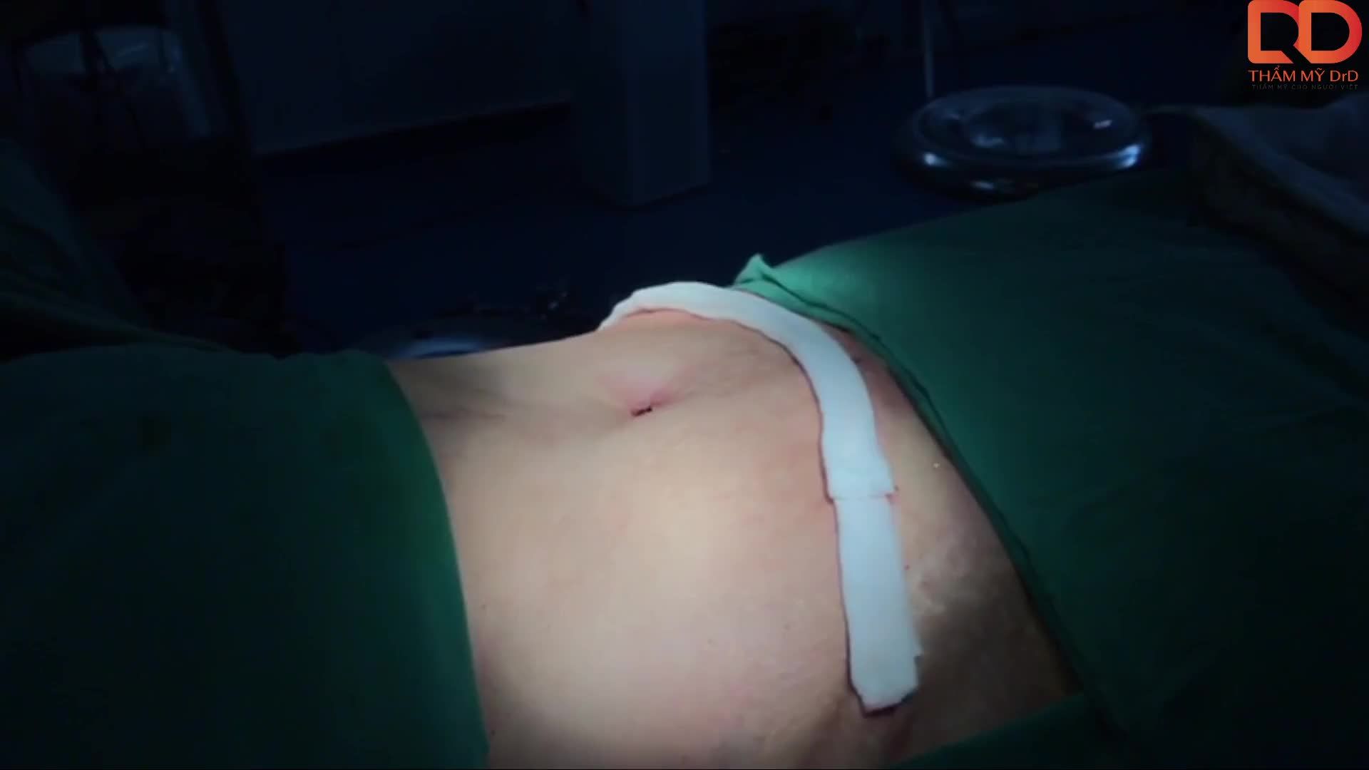 Kết quả ca tạo hình thành bụng  Vaser Lipo