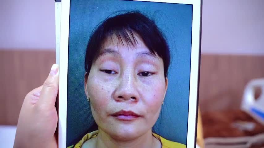 Dr.Hải Lê số 1 chỉnh hình phẫu thuật SỤP MÍ BẨM SINH