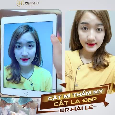“ TRÒN MẮT ” VỚI KẾT QUẢ CẮT  SAU 1 NĂM MÍ SẮC NÉT TƯƠI TẮN - TRẺ TRUNG ĐẸP RẠNG NGỜI