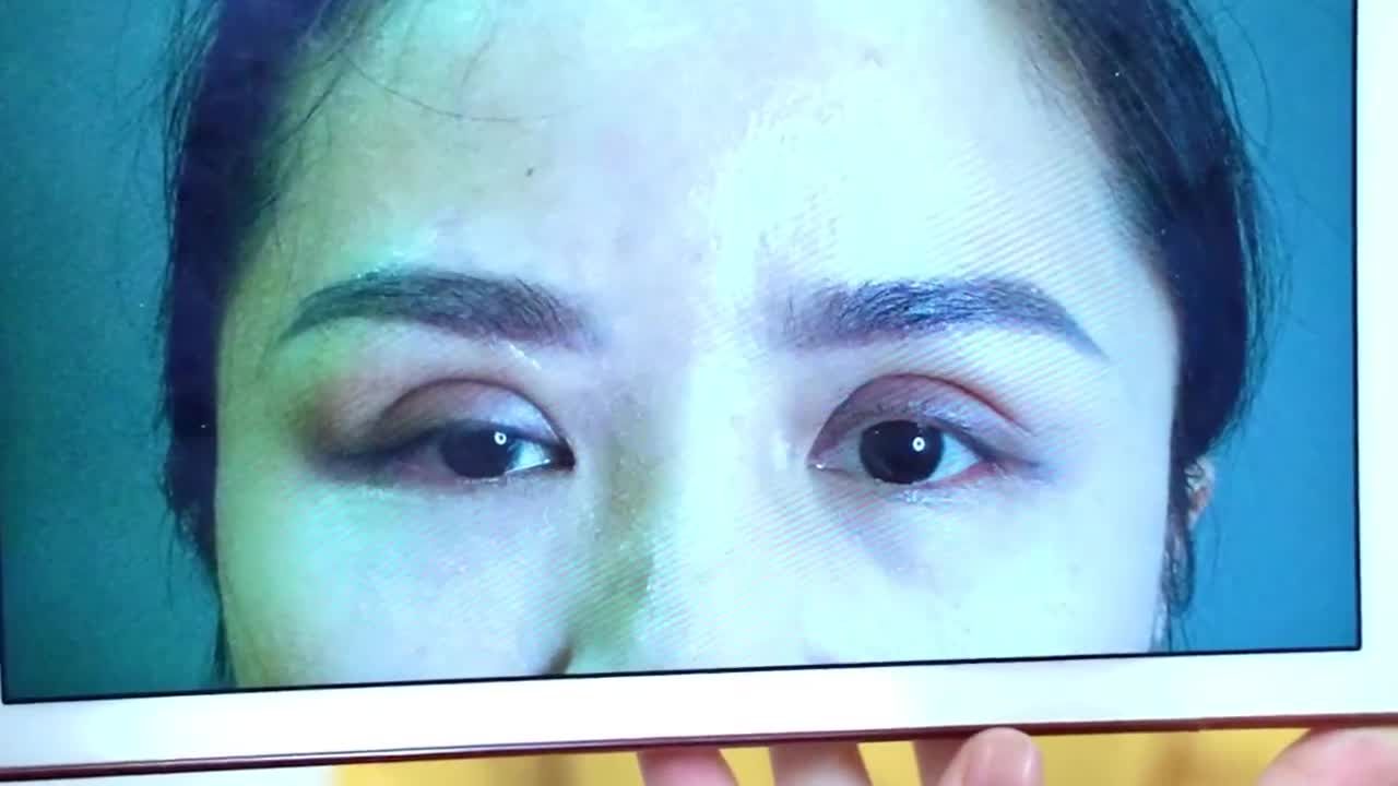 Mí hỏng ở mức độ nào bạn đừng quá lo lắng  đến ngay Dr.Hải Lê để khắc phục ngay bạn nhé!