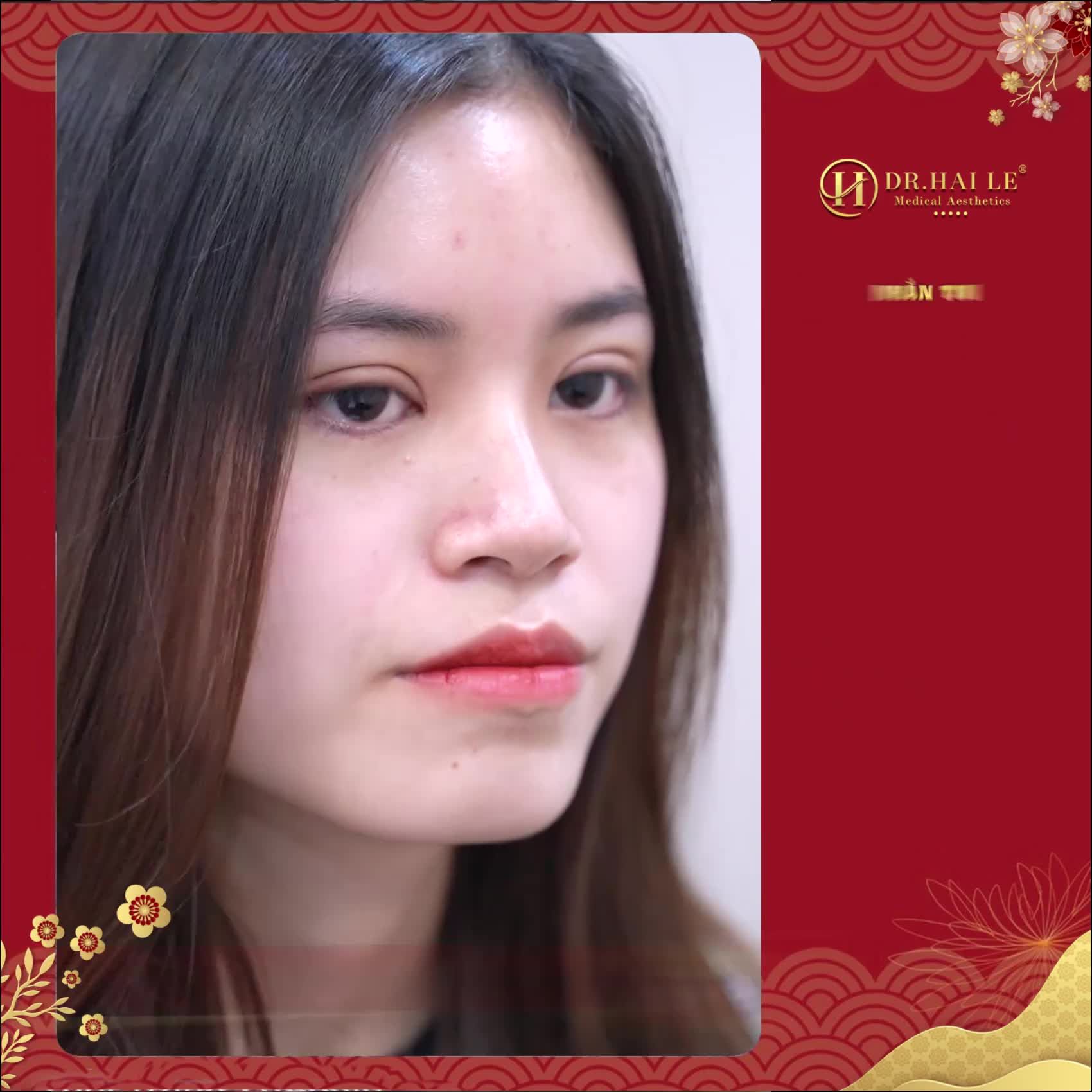NGÀY VÀNG ƯU ĐÃI  SĂN SALE XUYÊN TẾT - CẮT MÍ ĐẦU NĂM, MẮT ĐẸP NHƯ Ý, KHAI THÔNG TÀI LỘC CHỈ TỪ 5TR980.