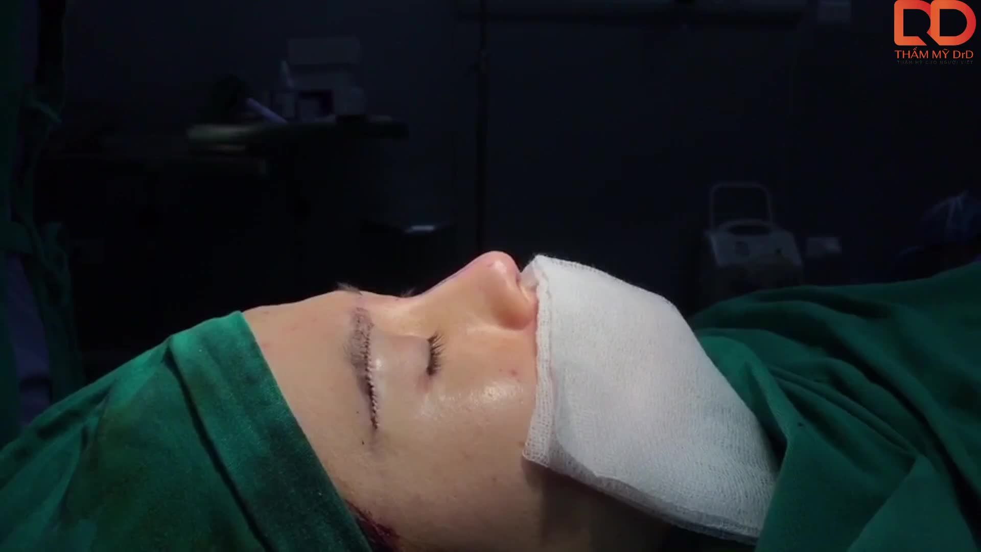 Khách hàng thực hiện combo nâng mũi + nâng cung mày tại Thẩm mỹ DrD.