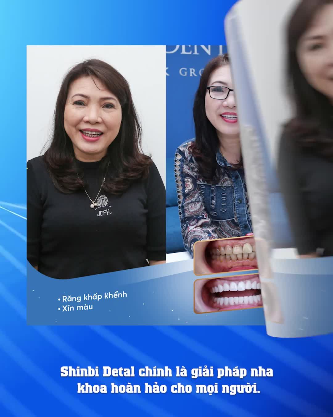 Bọc răng sứ KHÔNG MÀI NHỎ tại Shinbi