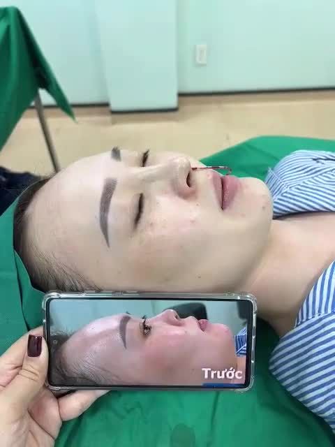 Cải thiện mũi thấp, tẹt cho chị khách ở Tây Ninh