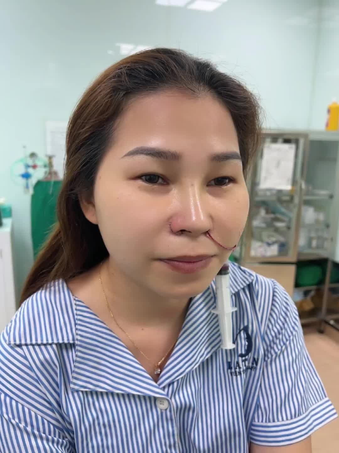 Dáng mũi trước của em khá thấp, ngắn, cánh mũi to; làm gương mặt kém sang và thiếu tự tin. Sau khi thực hiện nâng mũi, em gái có sự thay đổi rõ rệt.
