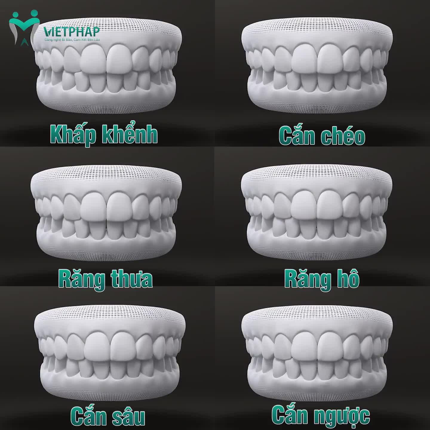 NIỀNG RĂNG SMART CLIP 3D - CÔNG NGHỆ CHỈNH NHA HIỆN ĐẠI NHẤT 2022