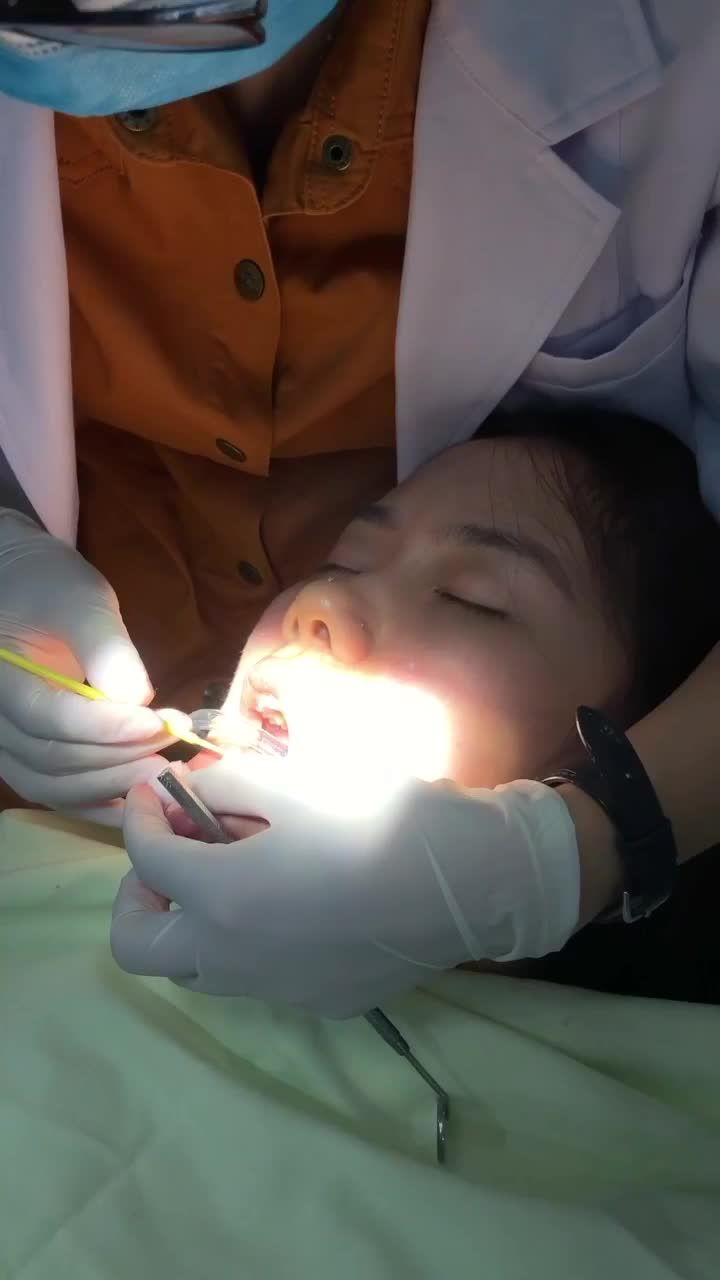 QUÁ TRÌNH DÁN SỨ VENEER CHO 1 NỮ KHÁCH HÀNG