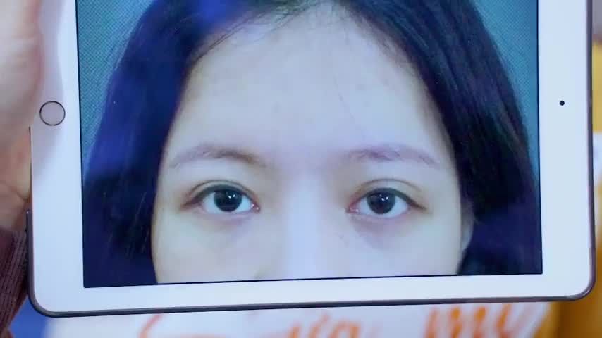 Mí lỗi hỏng nặng đến mức độ nào Dr.Hải Lê đều có thể giải cứu thành công với kỹ thuật chỉnh hình mí hỏng DeepTech