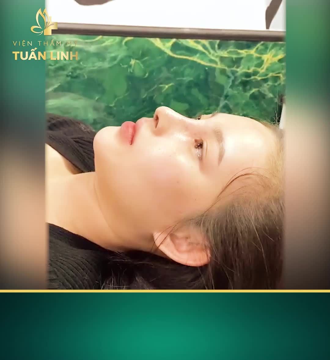 THÁO NẸP, TÁI KHÁM SAU 10 NGÀY NÂNG MŨI CẤU TRÚC!