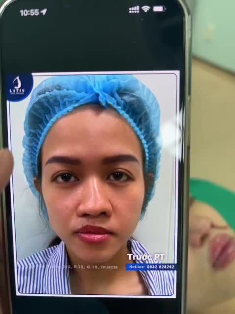 ca mũi bán cấu trúc và chỉnh hình môi bằng filler thành công mỹ mãn