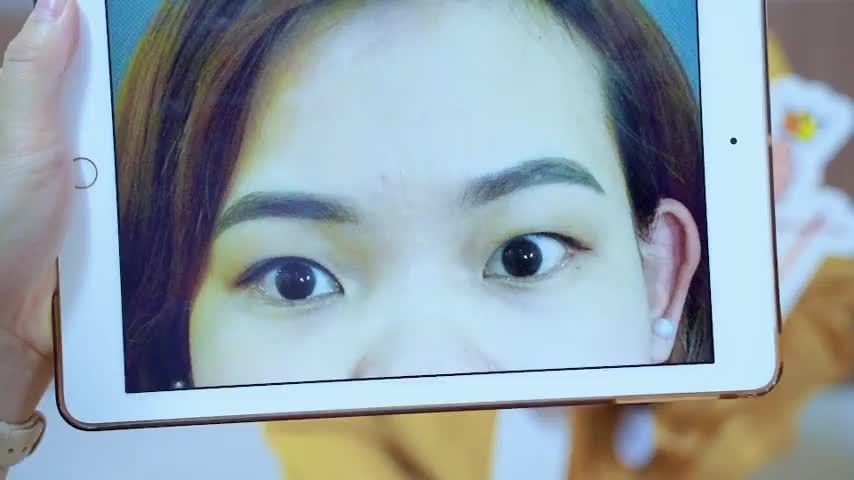 Một ca mí mắt cường cơ bẩm sinh rất khó nhưng thật may vẫn có thể khắc phục được khi đến Dr.Hải Lê!