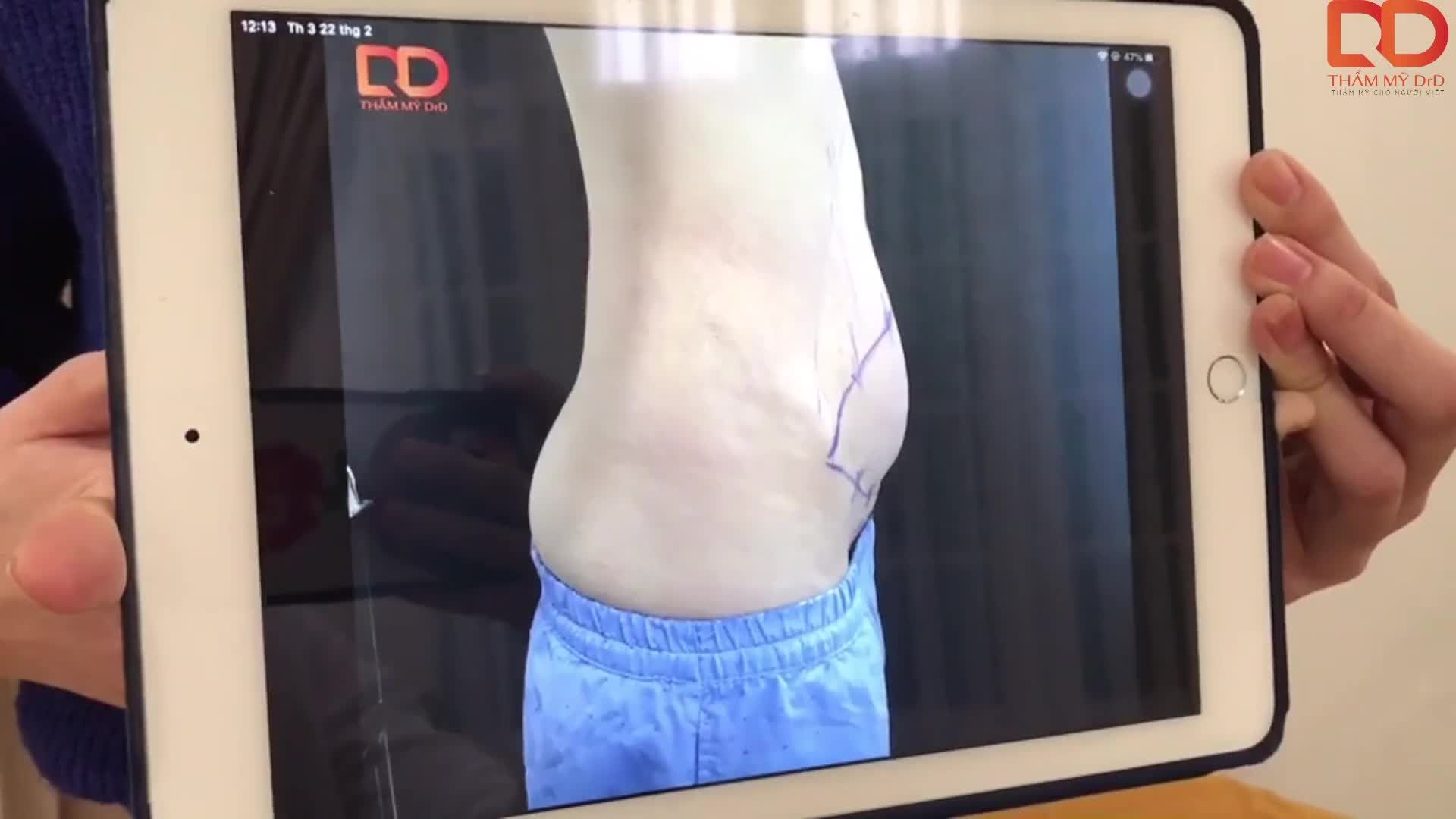 Khách hàng tạo hình bụng tại Thẩm mỹ DrD được 12 ngày.