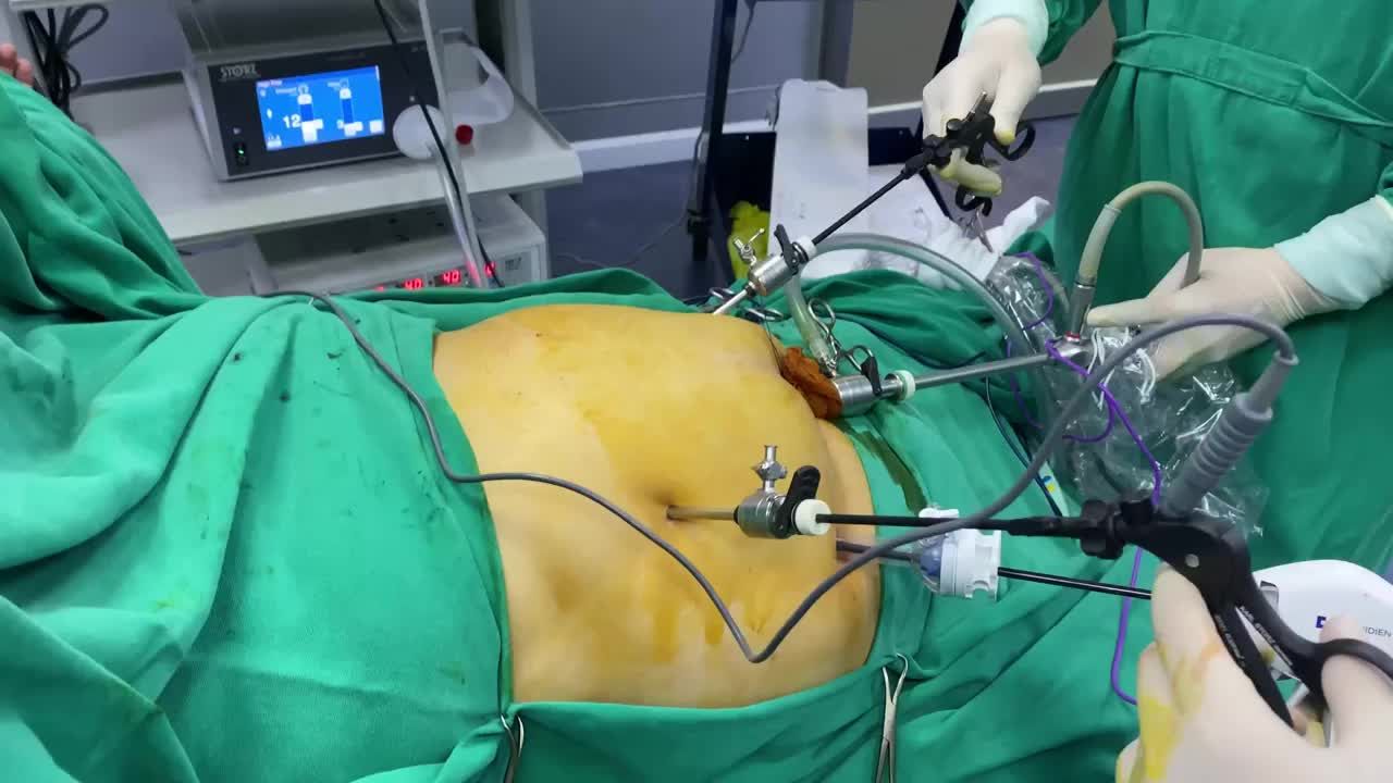 Không ngại đường xa, từ Đắk Nông ra Hà Nội, bệnh nhân 56 tuổi với BMI 31 đã quyết định tin tưởng & lựa chọn phẫu thuật nội soi Thu Nhỏ Dạ dày giảm béo