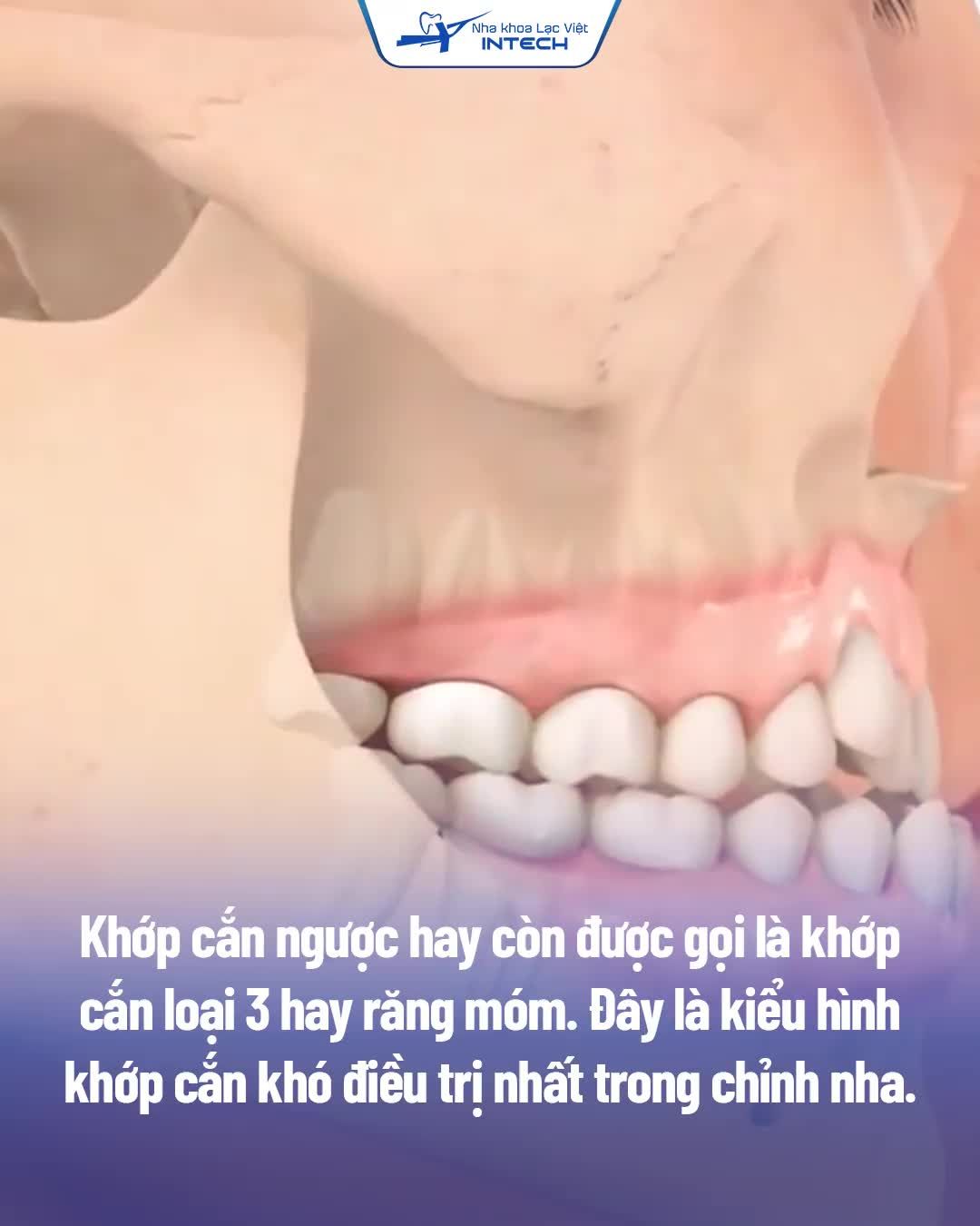 CÁCH NHẬN BIẾT KHỚP CẮN NGƯỢC VÀ HƯỚNG ĐIỀU TRỊ CỤ THỂ
