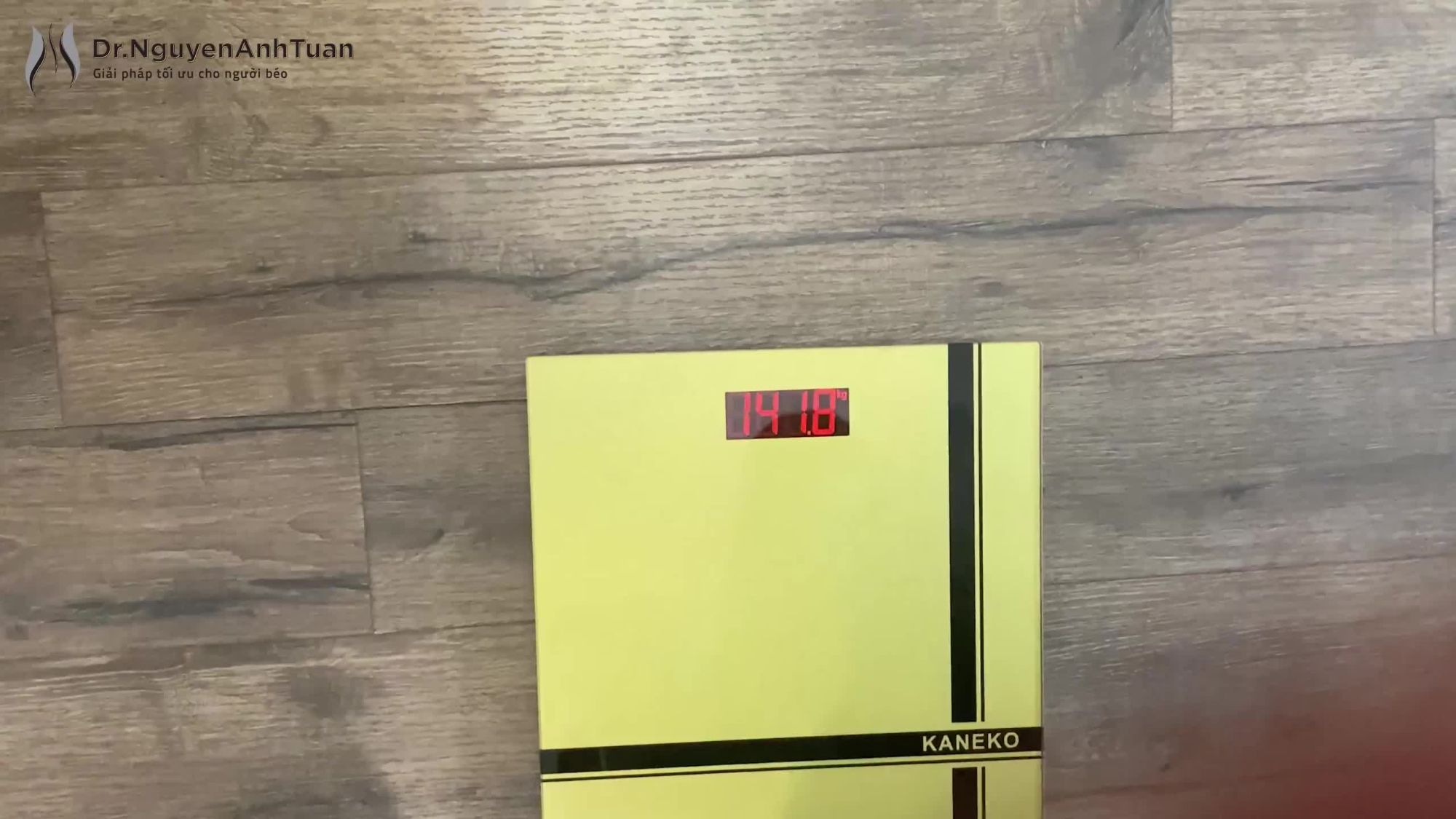 Nữ bệnh nhân 19 tuổi với cân nặng 141kg cùng gia đình đã đến gặp PGS.TS. Nguyễn Anh Tuấn với mong muốn được tư vấn thực hiện Thu nhỏ Dạ dày, thoát khỏi nỗi ám ảnh mang tên Béo phì