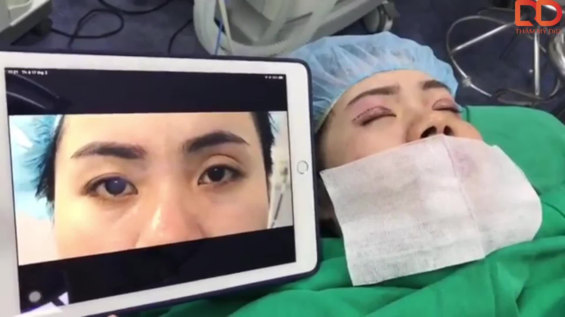 Khách hàng có nhiều vấn đề vùng mắt như  Nếp mí lệch, 2 mí không đều, thiếu mỡ hốc mắt khiến cảm giác già nua, không cân đối.