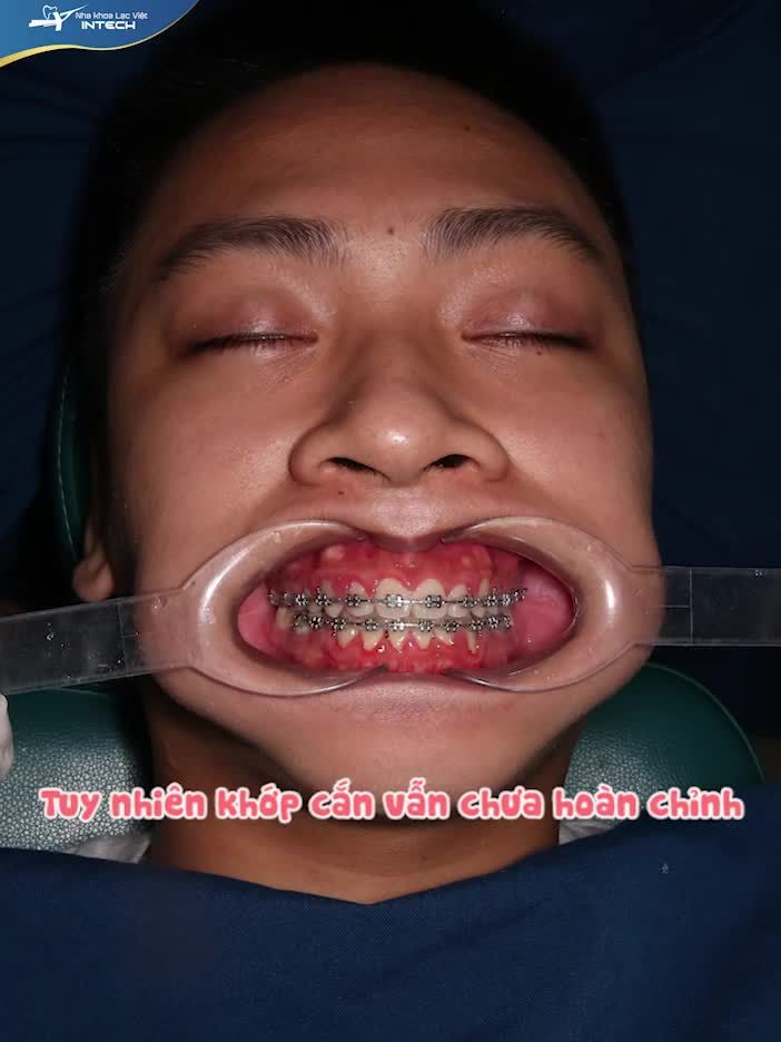 LỘT XÁC THÀNH HOTBOY NHỜ NIỀNG RĂNG