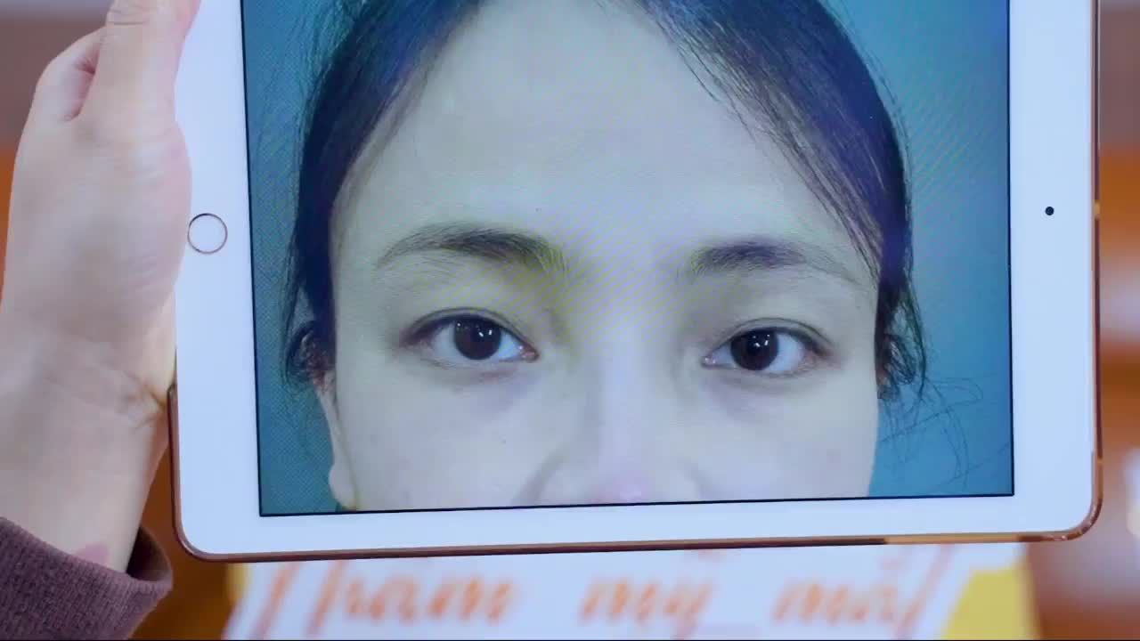 Mí sụp, không rõ nếp mí hay còn gọi là mí ẩn ... sẽ được cải thiện trong 30 phút tại Dr.Hải Lê.