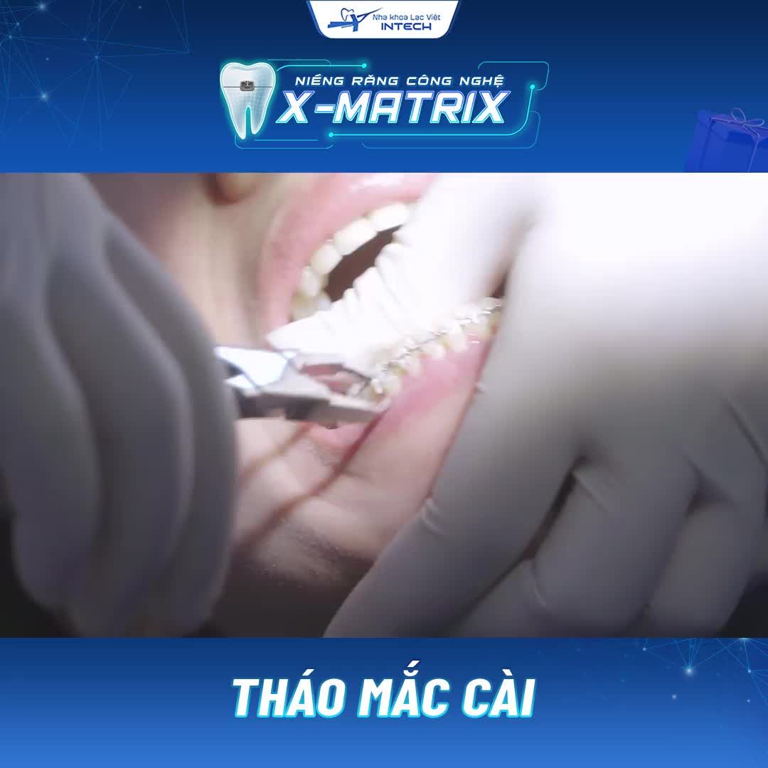 THÁO MẮC CÀI – ĐÓN RĂNG XINH NHỜ CÔNG NGHỆ NIỀNG RĂNG X-MATRIX