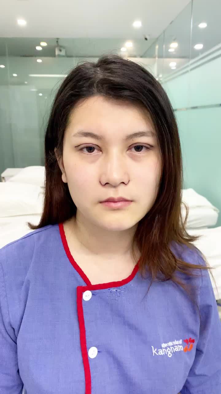 Combo Cắt mí Plasma + Thu cánh mũi tại Kangnam