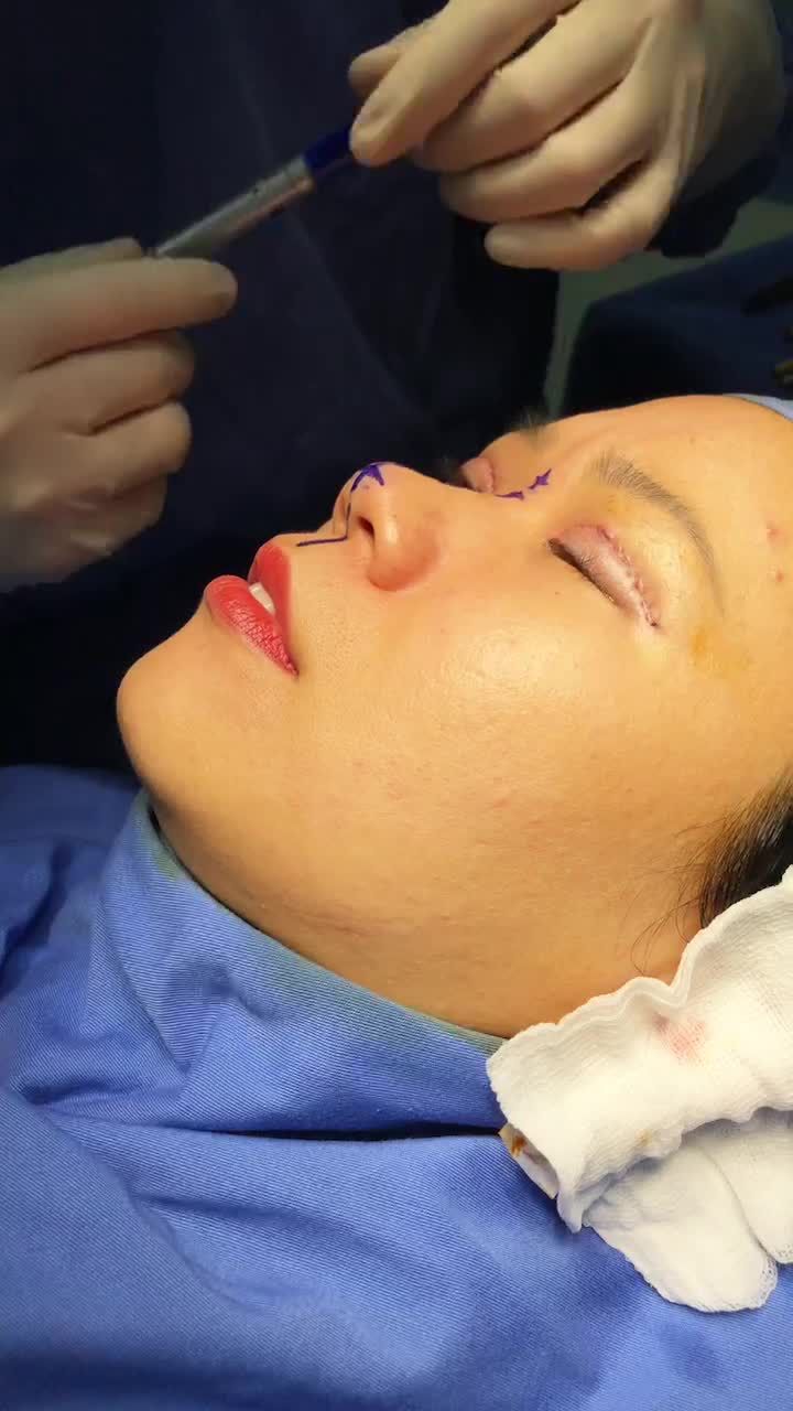 Quá trình bác sĩ Kangnam PT combo nâng mũi - cắt mí trên plasma tại BVTM KANGNAM