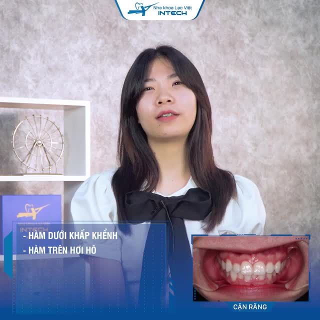 SẮM NGAY HÀM RĂNG ĐỀU ĐẸP, MẶT VLINE NHỜ NIỀNG RĂNG X - MATRIX