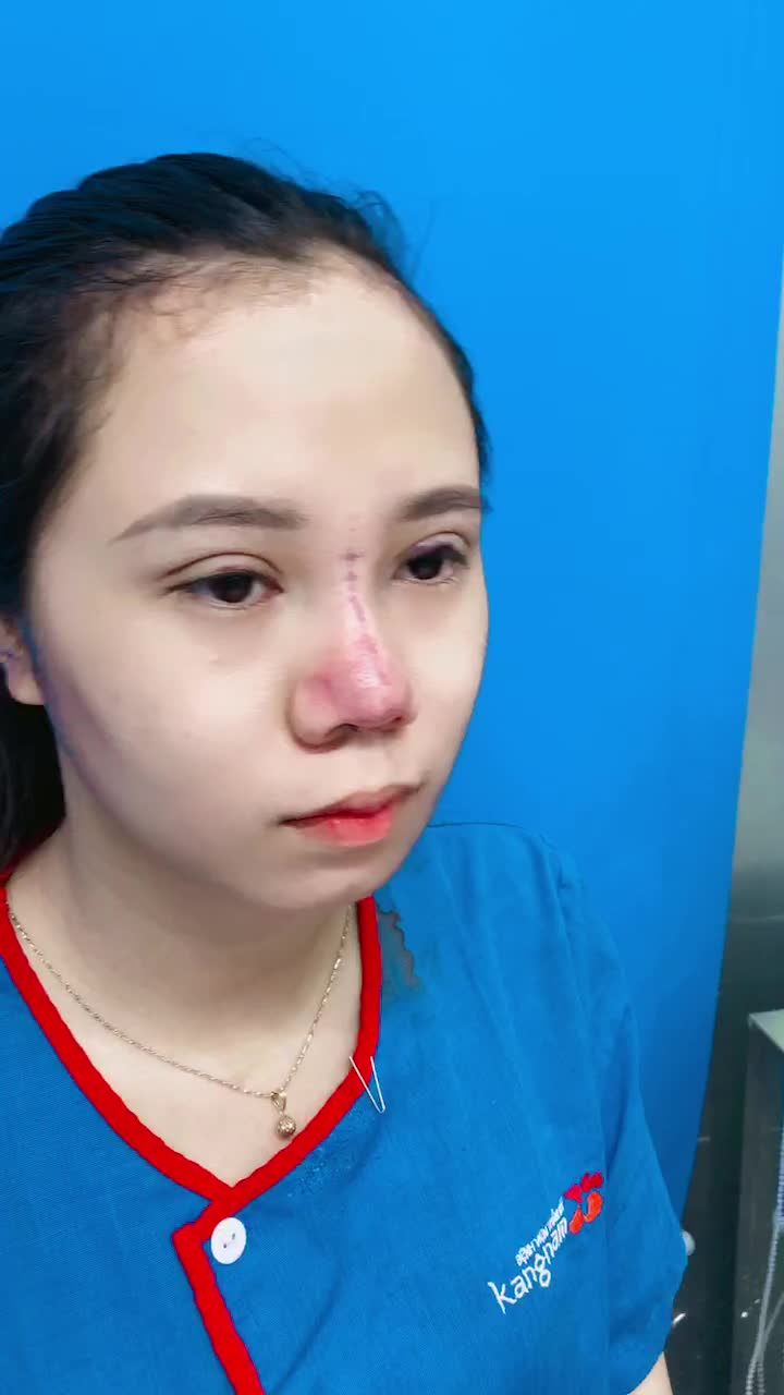 Kết quả combo nâng mũi - cắt mí tại BVTM KANGNAM - thay đổi 360 độ sau phẫu thuật