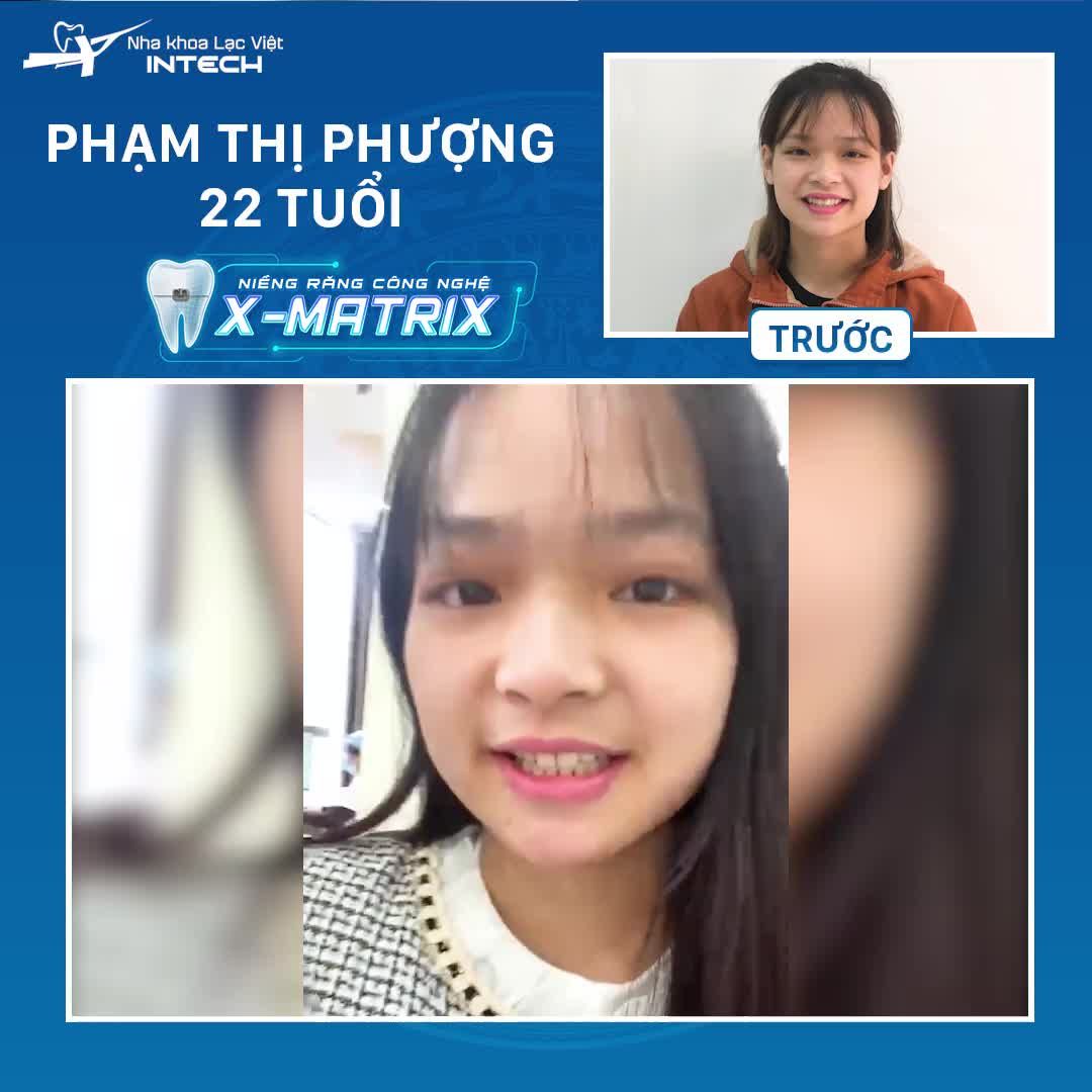 THOẢI MÁI CƯỜI TƯƠI NHỜ CÔNG NGHỆ X-MATRIX
